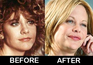 Meg-Ryan-before-after-plastic-surgery-photos