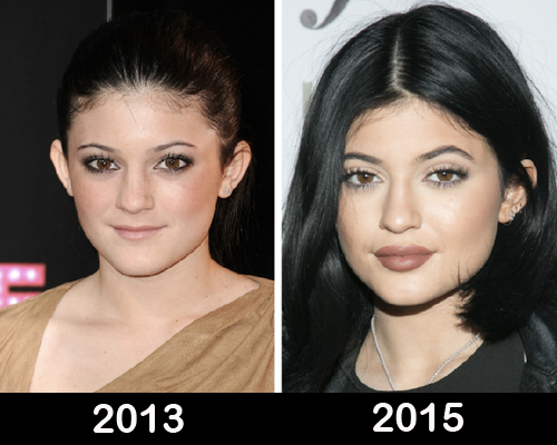 kylie-jenner-plastic-surgery-before-after-photos