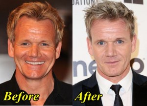 Ramsay B and A